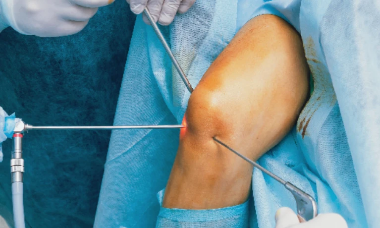 آرتروسکپی زانو و ربات صلیبی